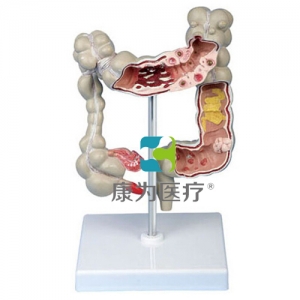 “康為醫(yī)療”大腸病變模型