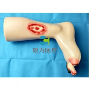 “康為醫(yī)療”糖尿病足護(hù)理模型,糖尿病足訓(xùn)練模型,糖尿病足腳趾截肢、夏柯氏足和壞疽模型