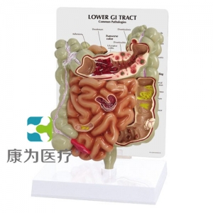 “康為醫(yī)療”醫(yī)患關(guān)系溝通模型-病理大、小腸模型（醫(yī)學(xué)指導(dǎo)模型）
