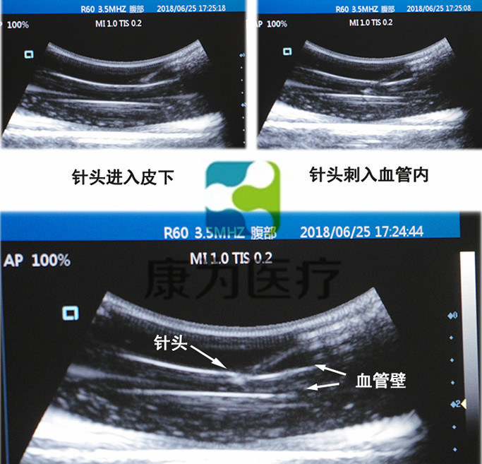 超聲引導下四肢血管活檢模塊